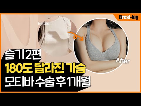 [슬기] 가슴성형 브이로그 2탄 | 당일부터 한달차 후기 | 사후관리 | 윈느성형외과 라벨윈느 유튜브 영상