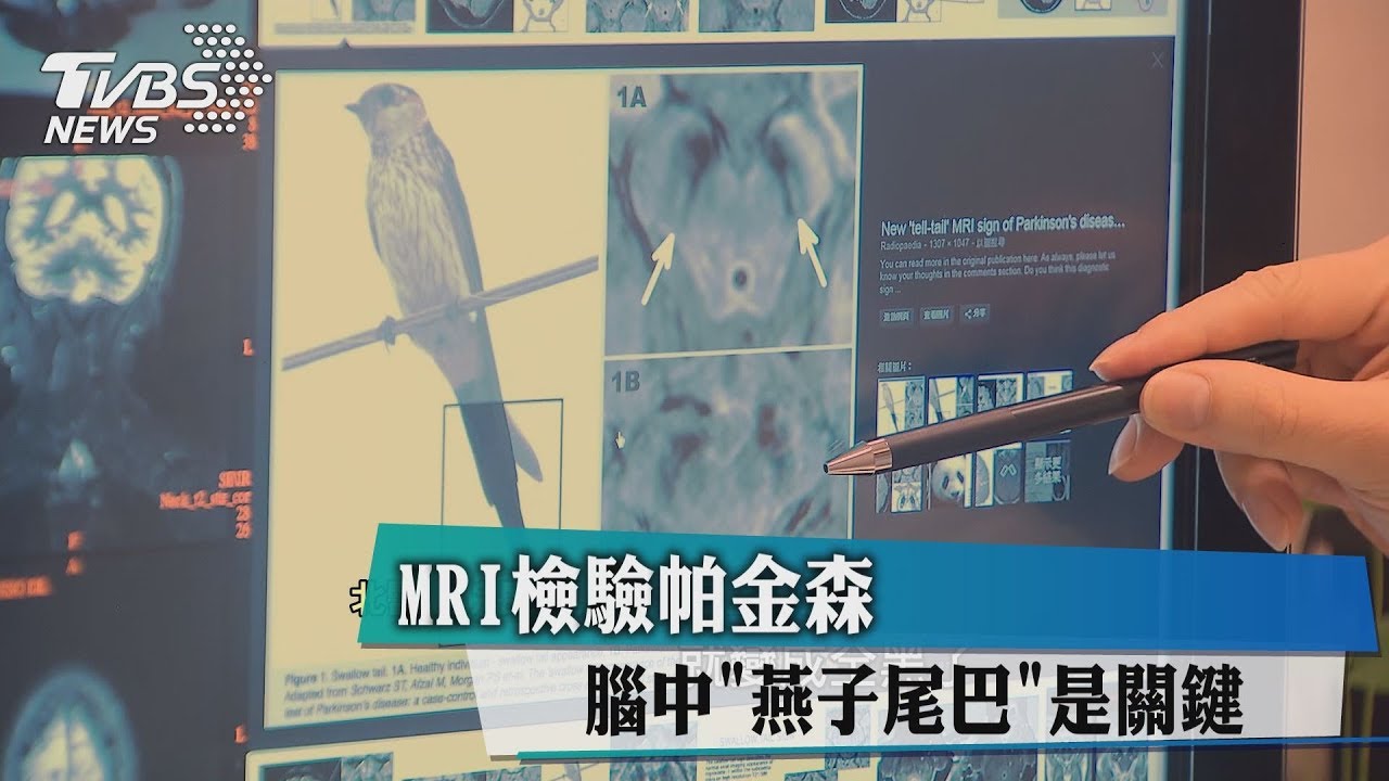 MRI檢驗帕金森 腦中「燕子尾巴」是關鍵