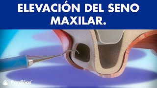 Elevación de Seno Maxilar © - Clínica Dental Pardiñas