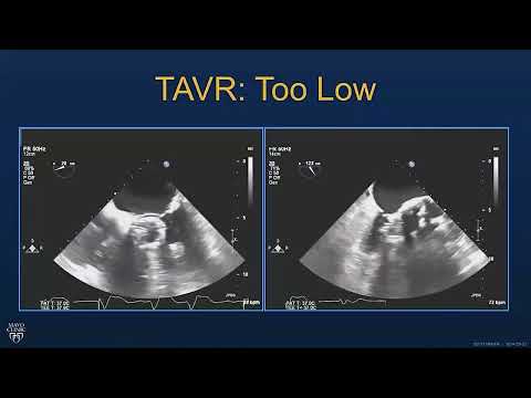 TAVR Complications