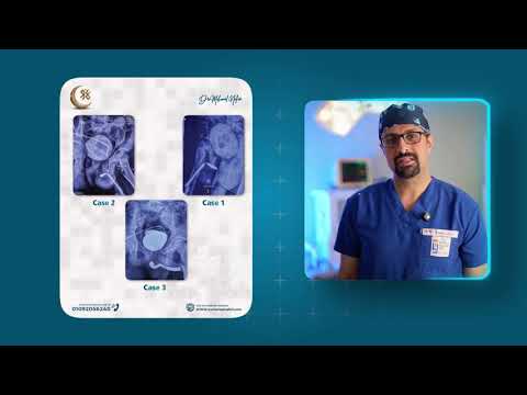 خبرة عالمية في جراحة المسالك البولية للاطفال والكبار