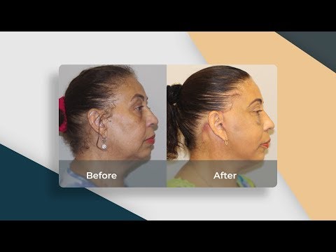 Face lift and neck lift onial by foeigner client from UK