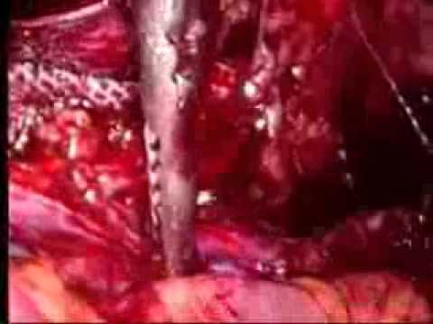 Laparoscopic Total Extraperitoneal Repair of Recurrent Bilateral Inguinal Hernias