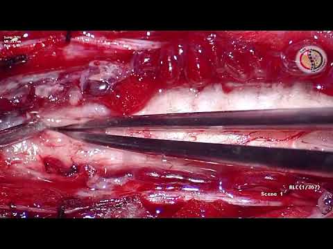 Spinal Intramedullary Solid Hemangioblastoma