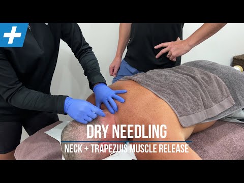 乾針鬆弛頸部和斜方肌！ | Tim Keeley | Physio REHAB (Dry Needling for Neck and Traps Muscle Release | Tim Keeley | Physio REHAB)