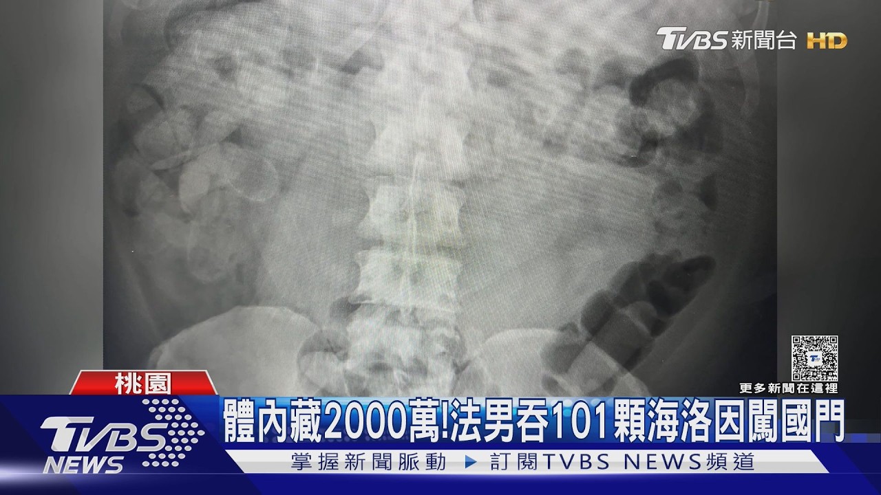 影音/體內藏2千萬!男狂吞101顆海洛因入境 花5天用「炸馬桶配方」排出