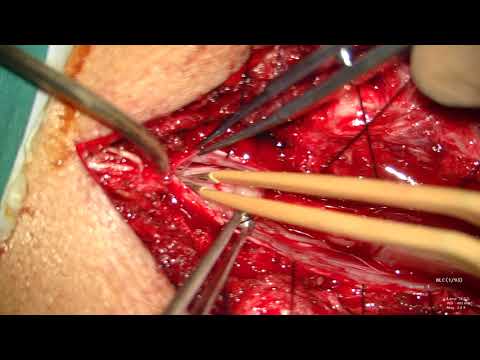 Resection Of Lumbar Schwannoma