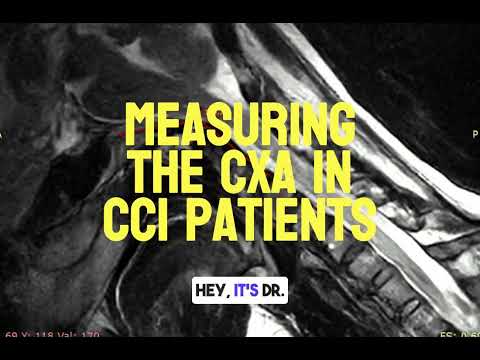 Measuring the CXA in CCI Patients