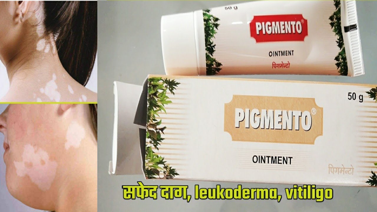 Pigmento ointment use benefits and side effects full review in hindi pigmento ointment use vitiligo