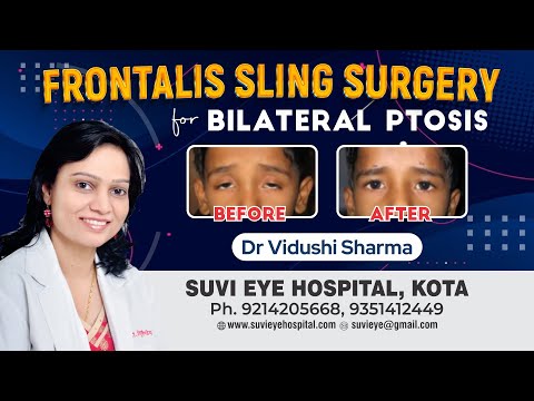 Frontalis Sling Surgery for Bilateral Ptosis