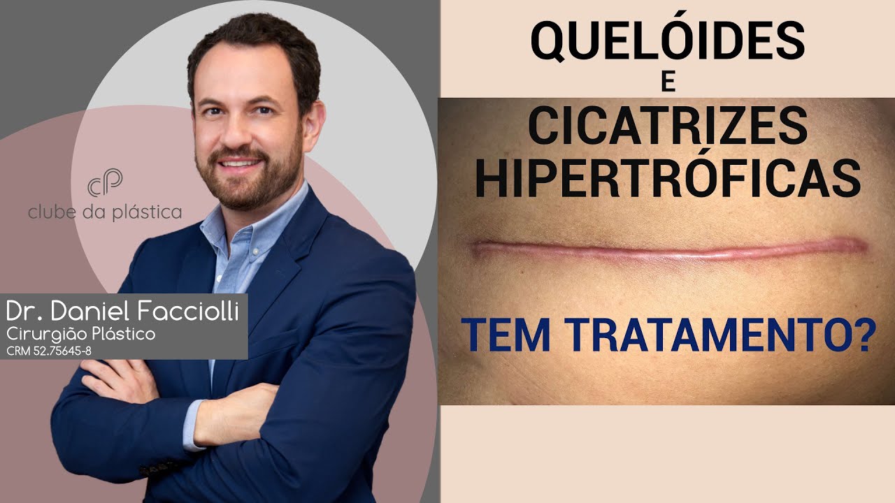 Clube da Plástica: Queloides e cicatrizes hipertróficas tem tratamento?