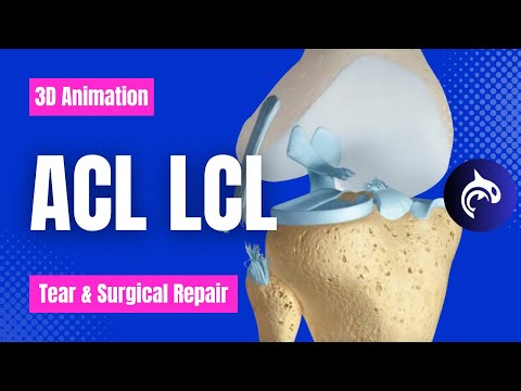 See how ACL LCL Tears are repaired - 3D Animation