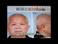 睡眠呼吸中止新救星！上下顎旋轉推進術