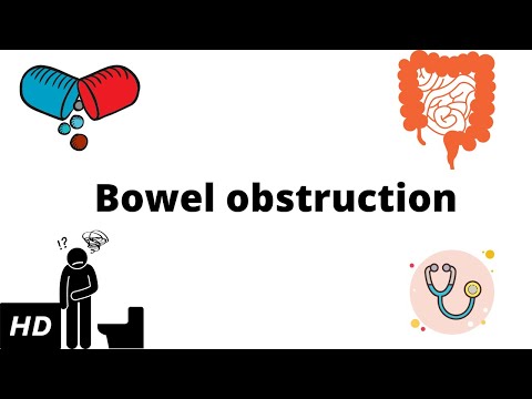 Bowel Obstruction, Causes, Signs and Symptoms, Diagnosis and Treatment.