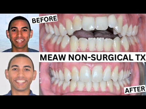 SEVERE OPENBITE CORRECTION using the MEAW Technique-NO SURGERY-Adult Braces- Open Bite Fix- Dr.Bass