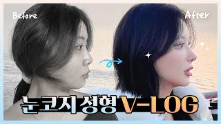 눈코지 성형 브이로그 | 보여줄게 완전히 달라진 나✨