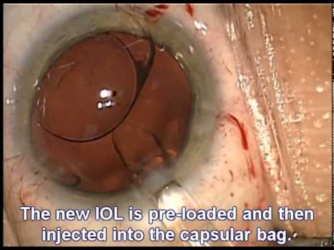 Cataract Surgery - Lens Exchange 