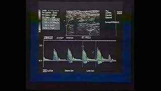 Carotid ultrasound