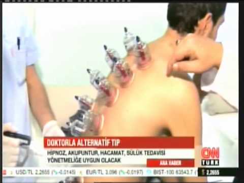 Sülük Tedavisi İle İlgili Haber ve Videolar