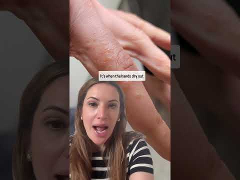 Itchy bumps on your hands? It may be this type of eczema