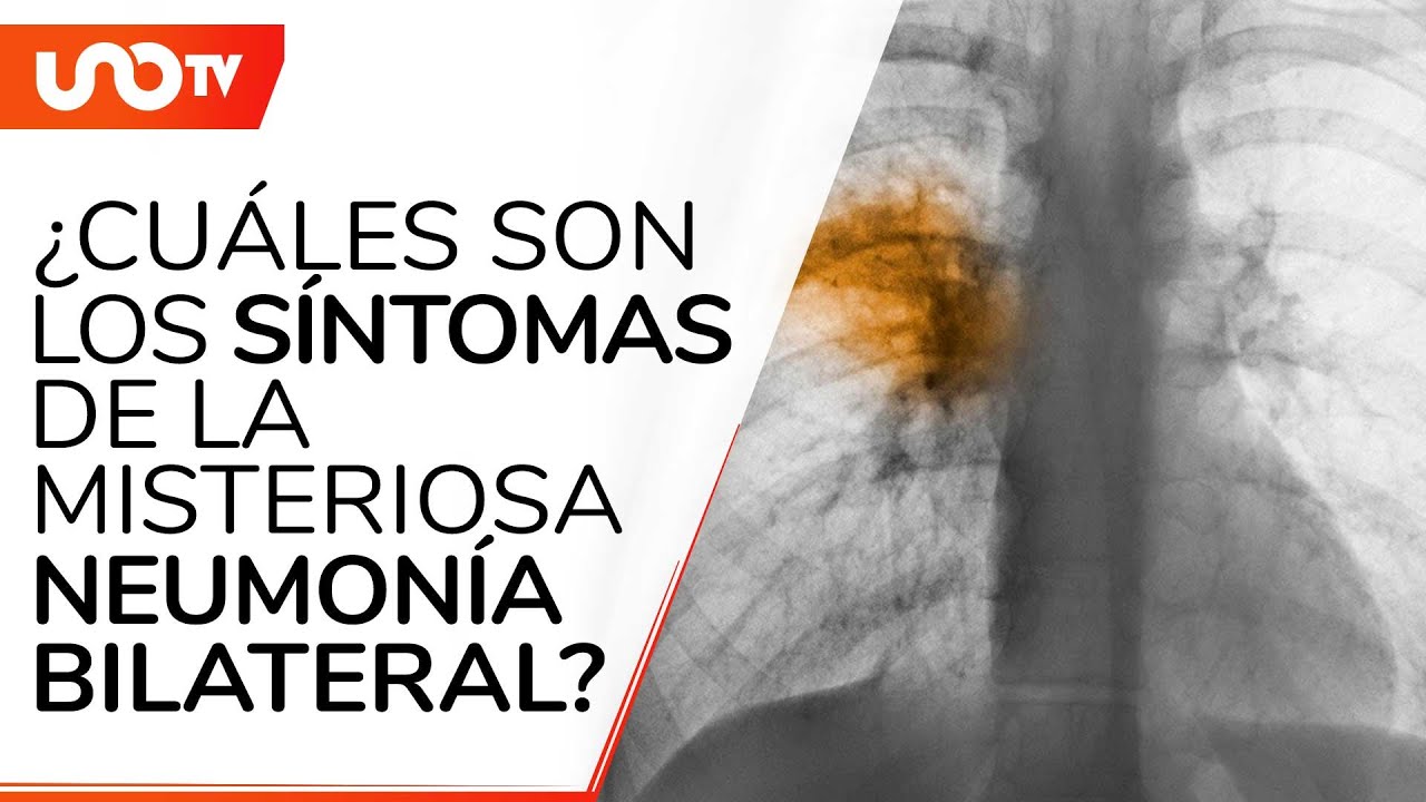 ¿Qué es la misteriosa neumonía bilateral surgida en Argentina