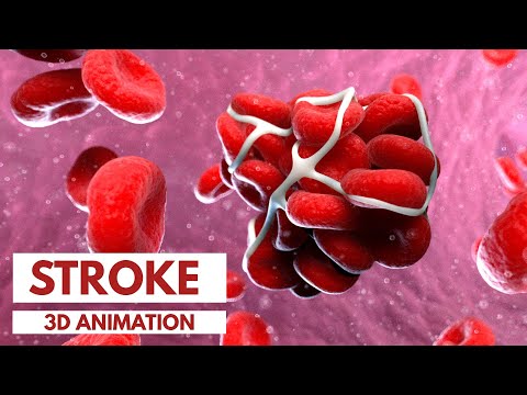 Understanding the Different Types of Stroke | 3D Animation