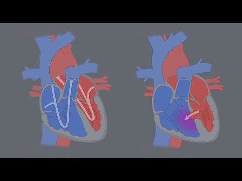 Congenital Heart Defects - What is a CHD?