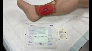 Product video: Sorbalgon Ag Calcium Alginate Dressing - Several Sizes