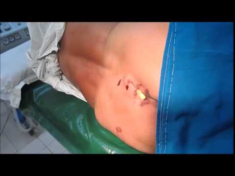 Epidural Steroid Injection for Sciatica