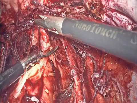 DISCOID ANTERIOR RECTAL WALL RESECTION with Conservative Endometriosis Surgery