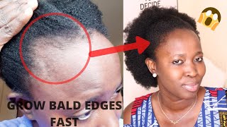 THIS TREATMENT WILL GROW & TREAT YOUR BALDNESS & THIN EDGES FAST IN 1 MONTH(Use 3 times weekly)