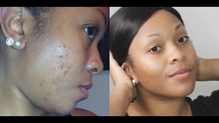 How To: Get Rid Of Dark Spots/Fade Acne Scars & Get Clear Skin