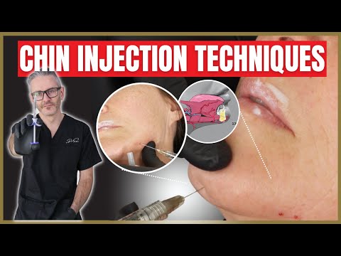 Chin Anatomy & Injection Techniques | Augmenting the Chin