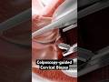 Taking a sample from the cervix (3D Animation)