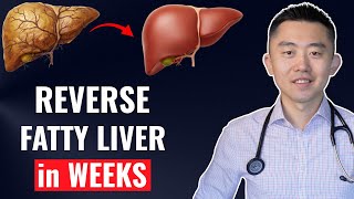 The FASTEST Way to Reverse Fatty Liver, Naturally