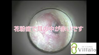 耳掃除動画vol.20「花粉症で耳の中が赤いです」