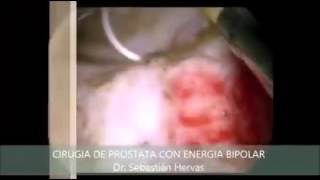 Cirugia de prostata energia bipolar, Dr. Sebastian Hervas