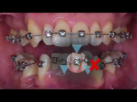 CC439. Clinical Tip: Stop Position