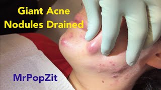 Giant inflammatory hormonal acne nodules drained and injected. Incision and drainage.