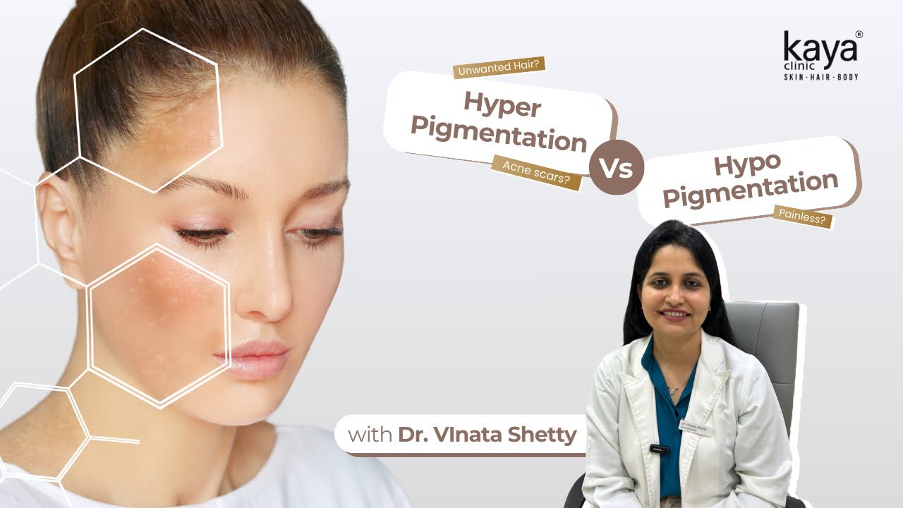Hyperpigmentation vs Hypopigmentation | Expert Talks | Dr. Vinata Shetty