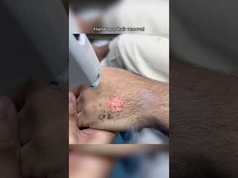 dont do this ipl laser hair removal