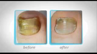 preview picture of video 'Podiatrist Toenail Infection Farmingdale NY | Call 516-755-5855 | 11735 | 11736 | 11737 | 11774'