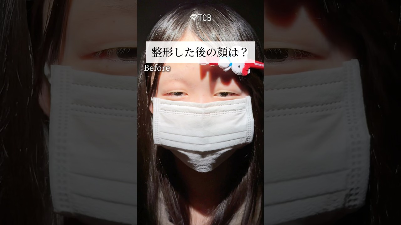 【二重整形】整形した後の顔は？ #shorts