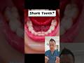 Dealing With Bottom Front Teeth Coming Out Crooked #shorts #dentalhealth #sharkteeth #dentist