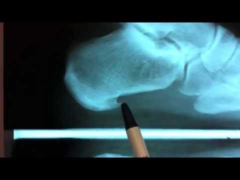 Ask Dr Moore Foot and Ankle FAQ Frequently Asked Questions Video Offering