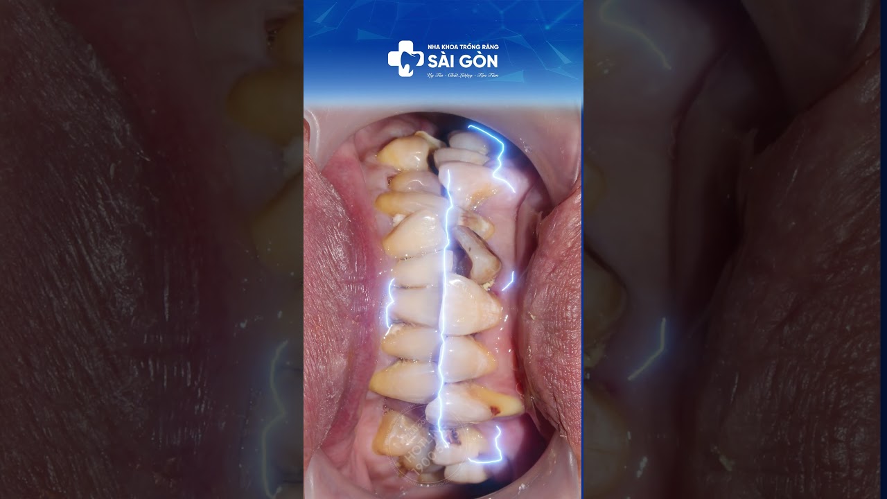 Case Bọc 22 Răng Toàn Sứ Khắc Phục Xỉn Màu, Khuyết Cổ Chân Răng | Nha Khoa Trồng Răng Sài Gòn