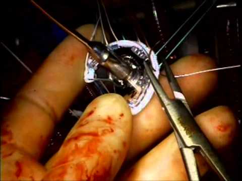 Mitral Valve Repair