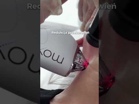 🤍Laserowe odmładzanie, redukcja przebarwień ✨