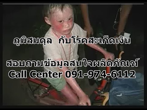 อาหารสำหรับโรคสะเก็ดเงิน Pagano กลไกการพัฒนาโรคสะเก็ดเงิน