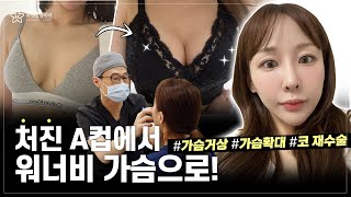 [가슴수술+코재수술 브이로그] 와 이 볼륨감 뭐야? 처진가슴 수술전후 대박이네♥